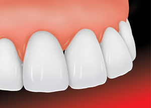 a ceramic veneer being placed on a chipped tooth