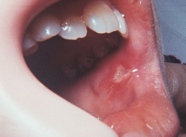 canker sores inside the mouth