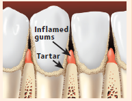 Inflamed gums and tartar