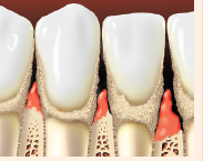 Teeth with tartar