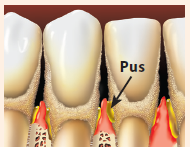 Teeth with pus