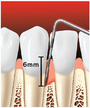 Periodontal probe showing a pocket forming between the tooth root and the gums