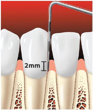 periodontal probe of healthy gums