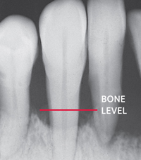 x-ray showing periodontal bone loss