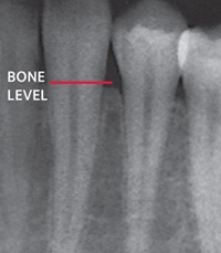 xray showing periodontal bone loss