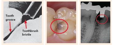 Places where tooth decay forms