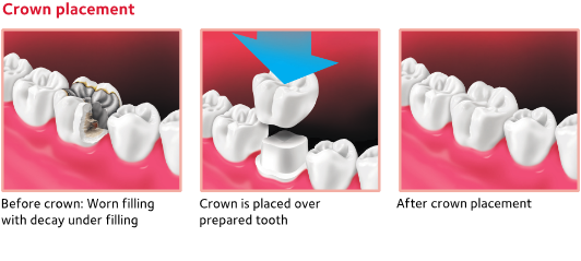 Diagram illustrating how a dental crown is placed