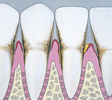 diagram of teeth with periodontis