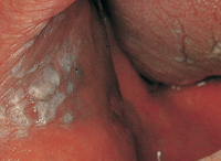 leukoplakia in the cheek